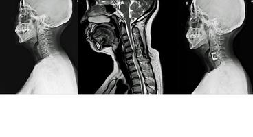 radiographie et irm du rachis cervical antécédent de douleurs cervicales, irradier vers les bras, exclure une arthrose cervicale. photo