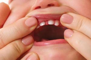 mère ouvrant sa petite bouche d'enfant avec des dents de lait en éruption dents de lait photo