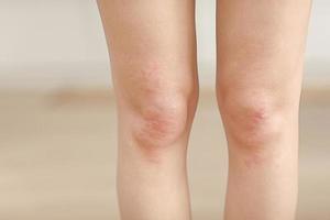 allergies cutanées, peau des jambes femmes. gros plan de pustules rouges sur un genou, une réaction allergique causée par la dermatite atopique. mise au point sélectionnée photo