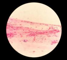 Frottis Paps sous microscopie montrant un frottis inflammatoire avec des changements liés au VPH. cancer du col de l'utérus. csc photo