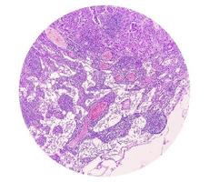 photomicrographie d'adénocarcinome de l'estomac. adénocarcinome gastrique. photo