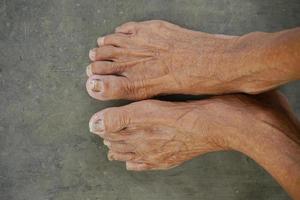 photo d'une paire de pieds de vieillards asiatiques avec des ongles négligés, vue de dessus