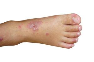 pied de bébé avec lésion de la maladie de la main, de la fièvre aphteuse. isolé sur fond blanc. photo