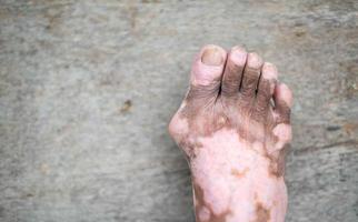 la jambe du vieil homme avec une affection cutanée qui provoque une perte de mélanine posant à l'intérieur. le modèle de pied en débardeur noir souffrant d'un trouble du vitiligo. photo