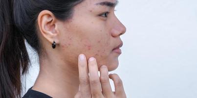 gros plan sur une jeune femme asiatique s'inquiète pour son visage lorsqu'elle a des problèmes de peau sur son visage. problèmes d'acné et de cicatrice sur la peau féminine. problème de soins de la peau et concept de santé. photo