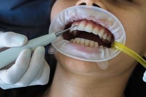 gros plan sur les dents d'une femme avec des instruments dentaires dans une clinique. photo