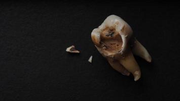 photo macro d'une dent cariée jusqu'à la racine après extraction du dentiste.