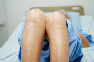 femme âgée asiatique patiente avec chirurgie de remplacement du genou cicatriciel à l'hôpital. photo