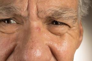 homme avec un bouton sur l'arête du nez photo