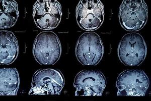 irm avec tumeur au cerveau. imagerie par résonance magnétique. photo