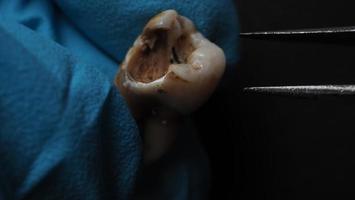 carie dentaire et main de dentiste avec gant et fond noir. photo macro d'une dent cariée jusqu'à la racine après extraction du dentiste. véritable anatomie dentaire due au manque de soins dentaires. vue de dessus des dents cariées