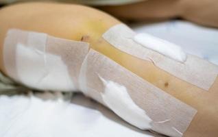 la vieille dame patiente montre ses cicatrices chirurgie de la plaie chirurgicale de la jambe cassée sur le lit dans le service de l'hôpital de soins infirmiers. photo