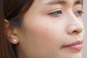 asiatique femme a acné sur sa visage photo