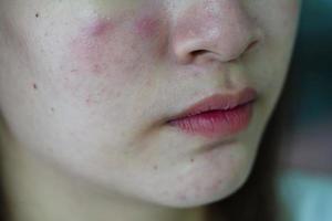 bouton d'acné et cicatrice sur le visage de la peau, troubles des glandes sébacées, problème de beauté des soins de la peau chez les adolescentes. photo