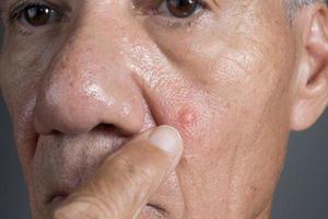 proche en haut de une homme avec une gros laid bouton sur le sien joue photo