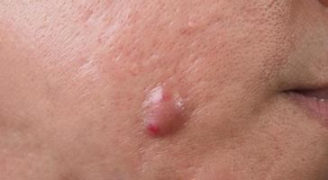 infection cutanée bactérienne. grand abcès de kyste d'acné ou zone enflée d'ulcère dans le tissu cutané du visage. contenant une accumulation de pus et de sang. photo macro d'acné ou de dermatite près de la bouche sur le visage. soins de la peau.