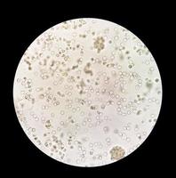 pyurie ou leucocyturie est le état de urine contenant blanc du sang cellules ou pus. il pouvez être une signe de une bactérien urinaire tract infection photo