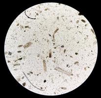 microscopique urine examen montrant granulaire jeter, une signe de beaucoup les types de un rein maladies. photo