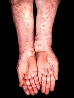 mains avec psoriasis photo