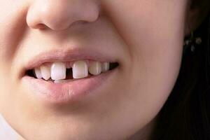 proche en haut de femme ouvert souriant bouche avec écart dents. lèvres et inhabituel les dents photo