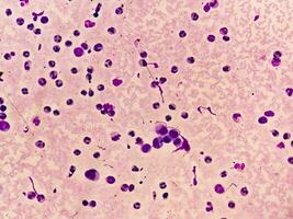 synovial fluide cytologie, beaucoup wbc, microscopique examen de synovial fluide, à diagnostiquer arthrite, particulièrement pour septique ou induite par les cristaux arthrite. photo