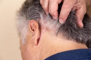 maladie de la peau psoriasique dans les plaques cutanées des cheveux