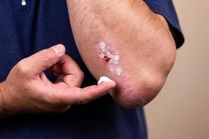 photo conceptuelle du traitement des maladies de la peau à l'aide de pommades comme dosage