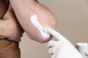 un dermatologue en gants applique une pommade thérapeutique sur la peau affectée d'un patient atteint de psoriasis