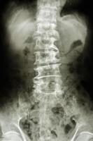 La radiographie du film de spondylose de la colonne lombaire montre un changement dégénératif d'un vieux patient photo