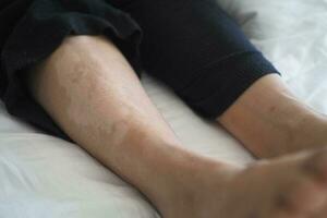 pieds avec vitiligo peau condition. photo