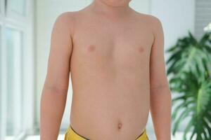 une enfant avec une pectus excavatum. rachitisme est une conséquence de vitamine ré carence. photo