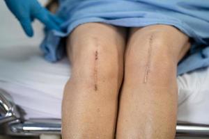 Asiatique senior ou vieille dame vieille femme patiente montrer ses cicatrices arthroplastie totale du genou chirurgicale