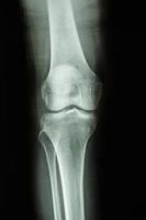 Film x ray genou ap voir montrer la vue avant de l'articulation du genou humain normal photo