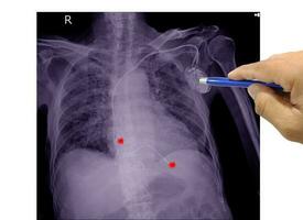 poitrine radiographie film de une patient avec permanent stimulateur cardiaque implant dans poitrine corps photo