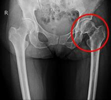 radiographie tous les deux hanche photo