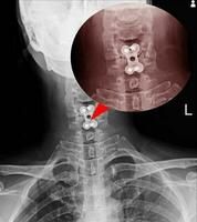 c-épine radiographie spinal fication de c5-6 corps non spinal dislocation photo