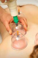 acupuncture femme thérapeute placement le tasse sur le retour de une femelle patient. photo