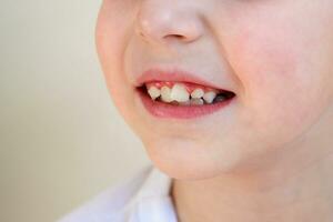 enfant a courbé dents. le concept de surpeuplement de molaires. photo