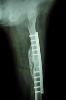 fracture de la diaphyse du fémur. il a été opéré et fixation interne par plaque et vis photo