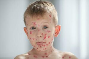 portrait de une grimaçant garçon avec une téméraire sur le sien visage de poulet variole. varicelle dans une enfant est traité avec une rouge guérison crème sur le enfant peau. photo