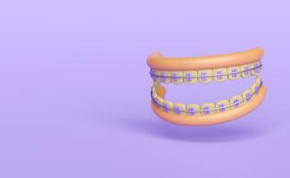 3d orthodontie dessin animé, les dents un appareil dentaire avec gencive isolé sur violet Contexte. 3d rendre illustration photo