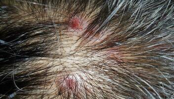 croûtes sur le cuir chevelu, blessure sur le cuirs chevelus ou lichen planus folliculaire capillaires, démanger sur le cuirs chevelus photo