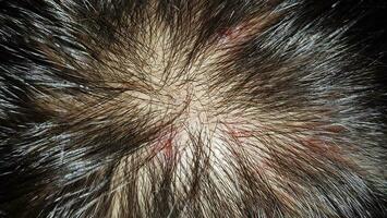 croûtes sur le cuir chevelu, blessure sur le cuirs chevelus ou lichen planus folliculaire capillaires, démanger sur le cuirs chevelus photo