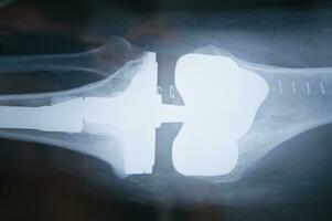 une X - rayon image de une personne retour photo