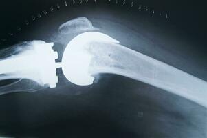 une X - rayon image de une personne retour photo