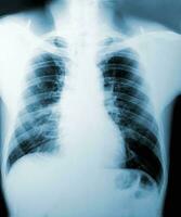 image radiographique, vue des hommes de la poitrine pour un diagnostic médical. photo