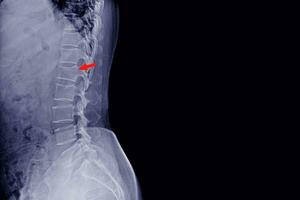 radiographie lombaire colonne vertébrale fracture l1 sur rouge indiquer. photo