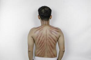 rouge Des marques de éraflures pièce de monnaie sur une homme dos. kérokan est une façon de traditionnel Javanais culture médical traitement à traiter symptômes de rhumes dans Indonésie photo