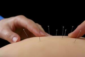 acupuncture traitement. produire ai photo