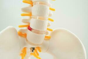 spinal nerf et os, lombaire colonne vertébrale déplacé hernie disque fragment, modèle pour traitement médical dans le orthopédique département. photo